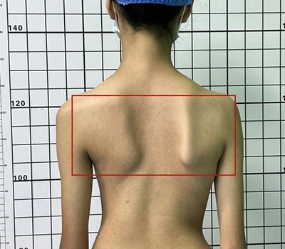 Valutazione completa della scoliosi: comprendere, identificare e affrontare la salute della colon...