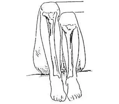 Valutazione della discrepanza della lunghezza delle gambe (LLD): una guida pratica per applicazio...