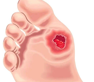 Valutazione del piede diabetico: approfondimenti clinici, gestione del rischio e opportunità comm...