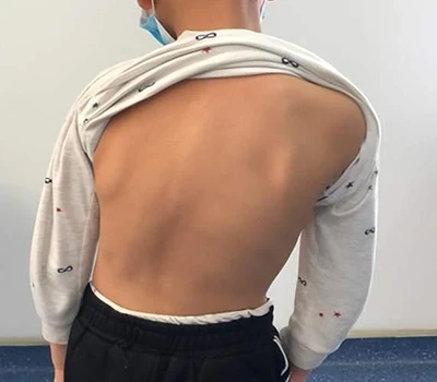 Screening e gestione della scoliosi: come Xianku 3D Body Scanner aiuta i chiropratici