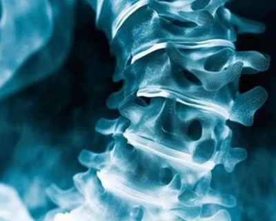 Screening della scoliosi tramite intelligenza artificiale e monitoraggio dell'allineamento spinal...