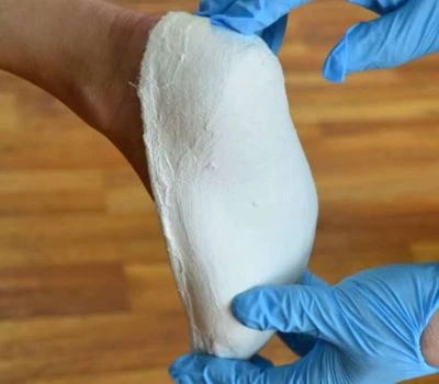In che modo gli scanner 3D del piede trasformeranno il futuro dei dispositivi di supporto ortoped...