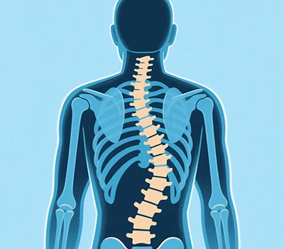 Scoliosi: scanner del corpo 3d Xianku, 3D+AI, prevenzione e correzione della scoliosi