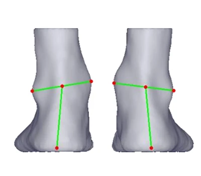 Tacco Valgus e Varus: una minaccia silenziosa attraverso