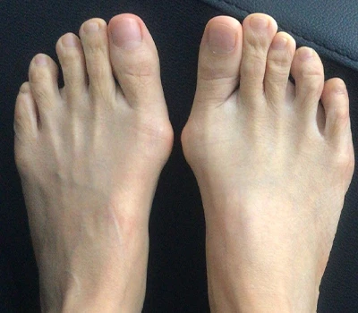 La misurazione di Hallux Valgus: perché gli scanner 3D stanno superando i medici e gli ospedali
