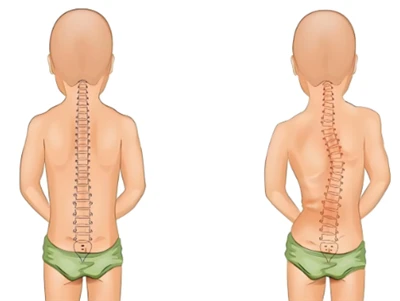 Nuovo metodo di screening della scoliosi: AI e colonna vertebrale digitale 3D